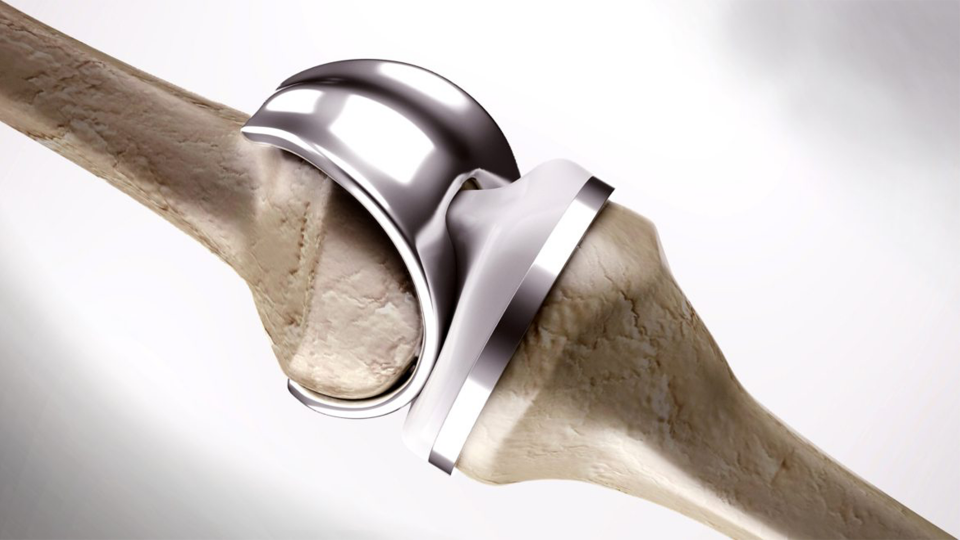 Diz Protezi Hangi Kompenetlerden Oluşur?